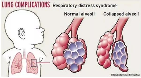 早产儿护理疑难解答:黄疸、呼吸问题等常见病症处理方法