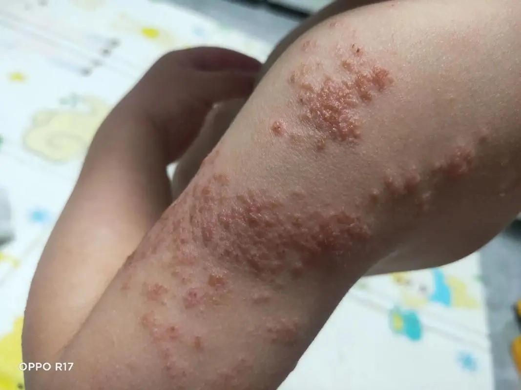 婴幼儿常见皮肤问题应对策略:湿疹、尿布疹等